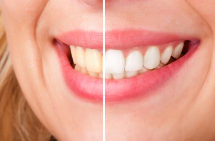 before and after teeth whitening | teeth whitening centennial co