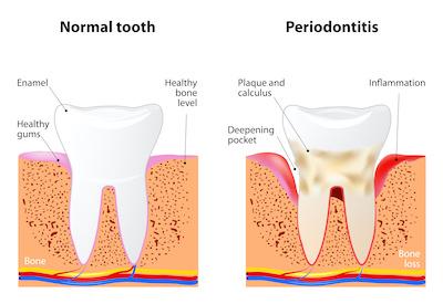 image of healthy gums and unhealthy gums