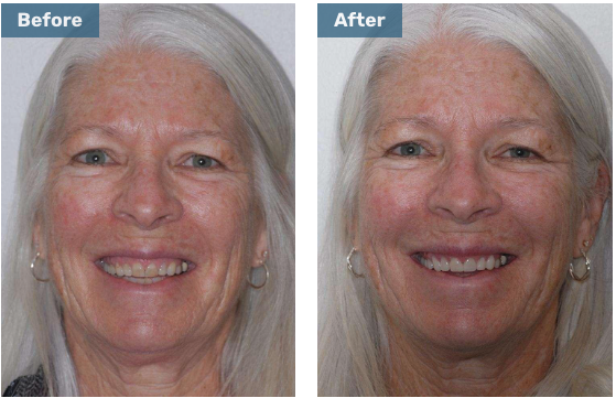 Before and after cerec crowns full smile
