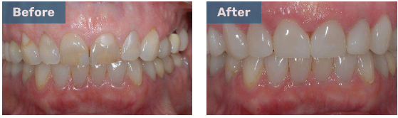 Before and after close up of mouth with crowns
