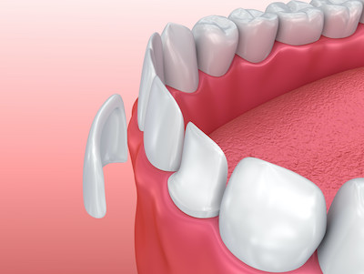 Veneer going over tooth