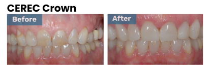 cerec crown before and after| same-day crowns centennial