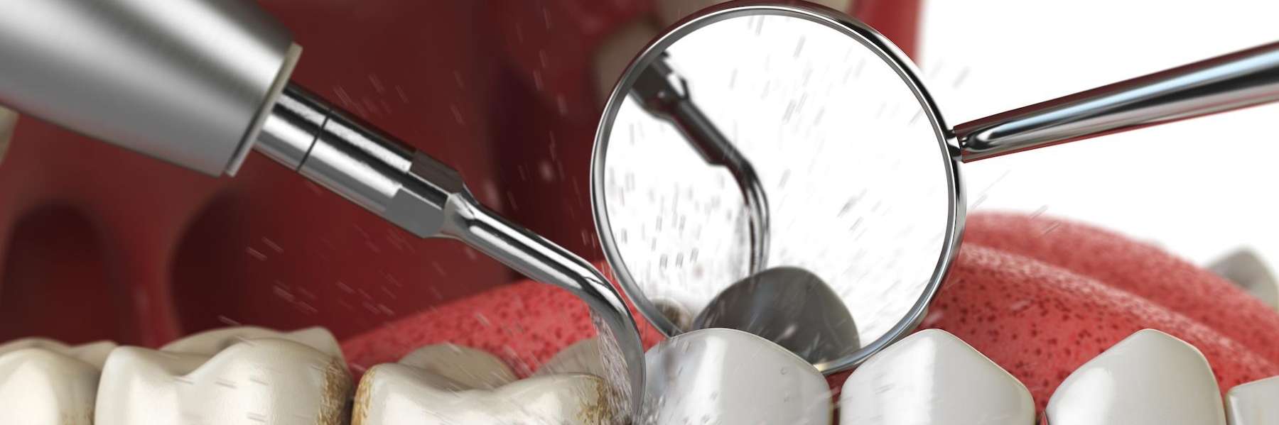 image of a teeth cleaning in centennial 