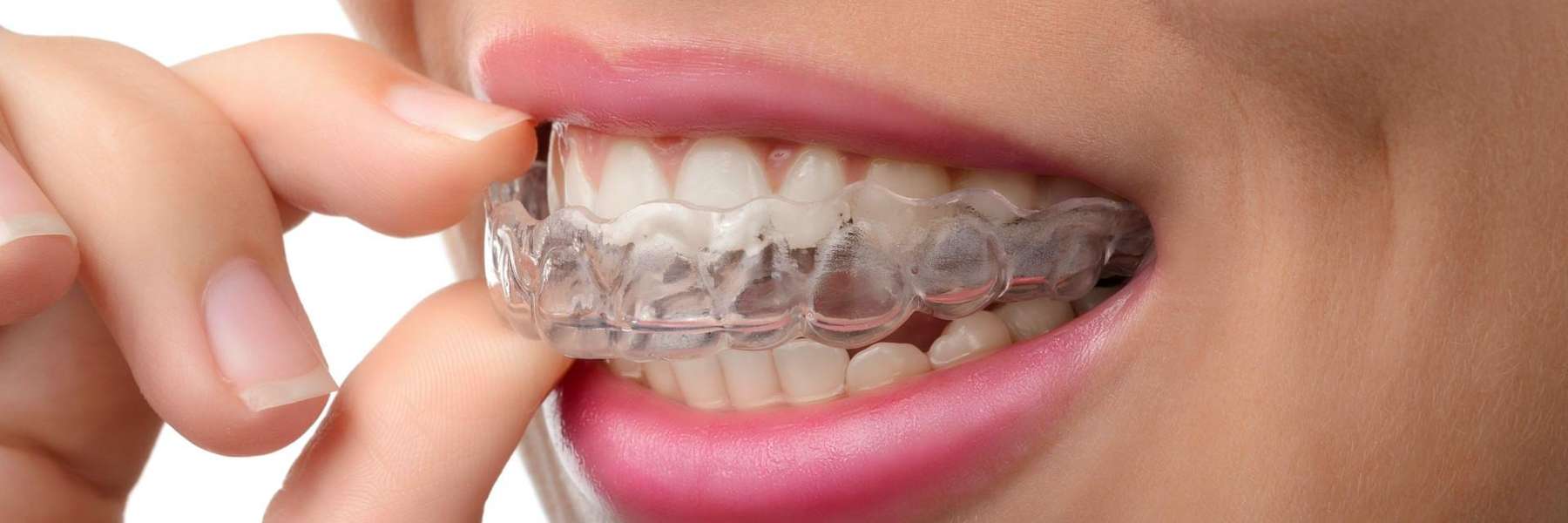 patient putting in clear plastic aligner | centennial co dentist