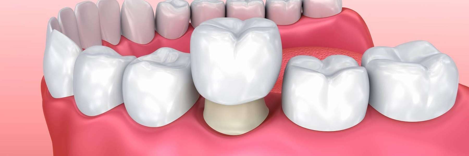 close up of dental crown | dentist centennial co