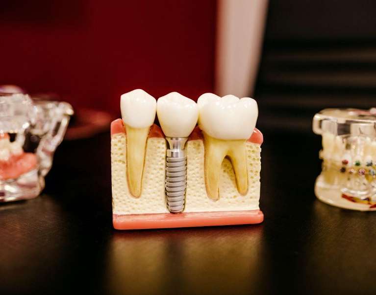 image of a dental implant