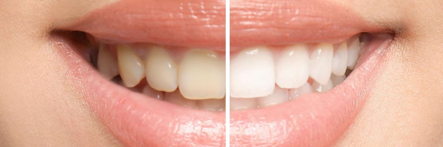 before and after teeth whitening results in centennial co