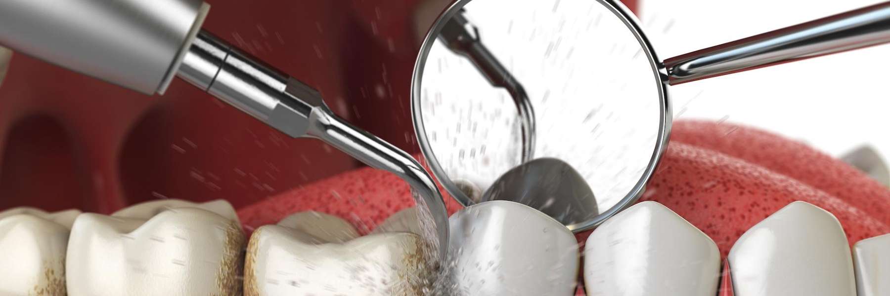 teeth cleaning in centennial co