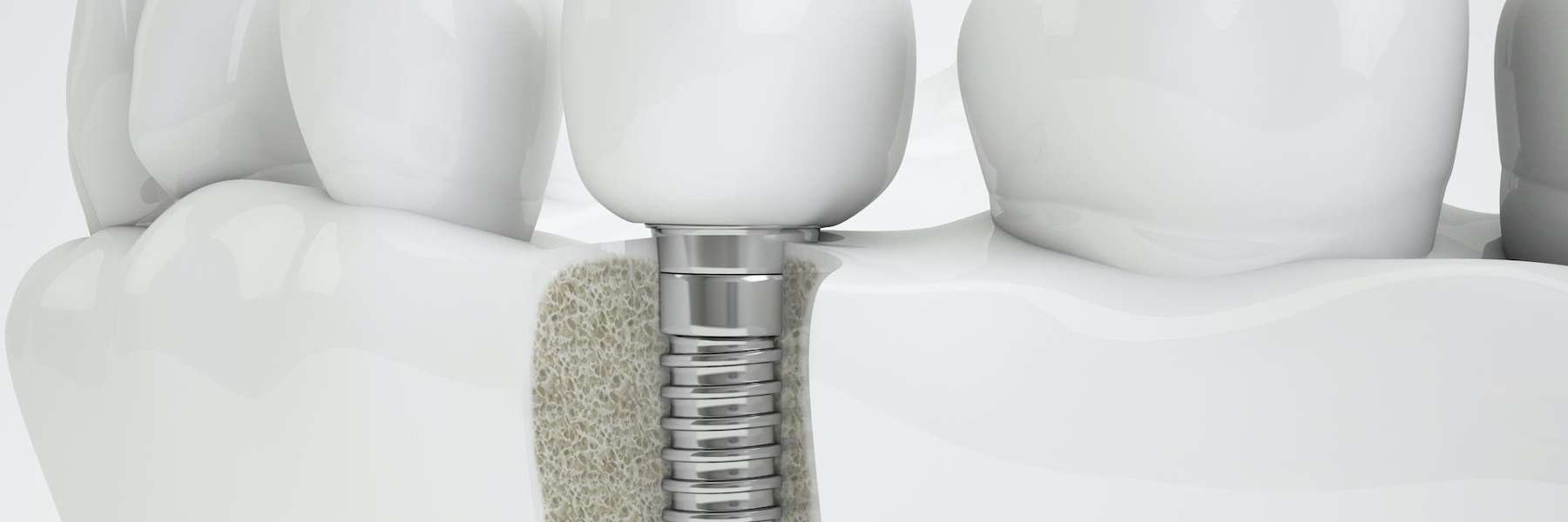 close up of dental implant in jaw | centennial co dentist