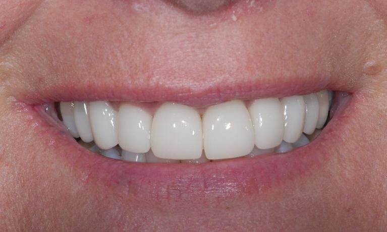 CEREC-Same-Visit-Crowns-in-Centennial-CO-After-Image