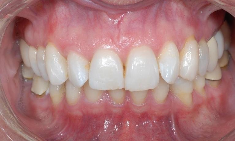 CEREC-Same-Visit-Crowns-in-Centennial-CO-Before-Image
