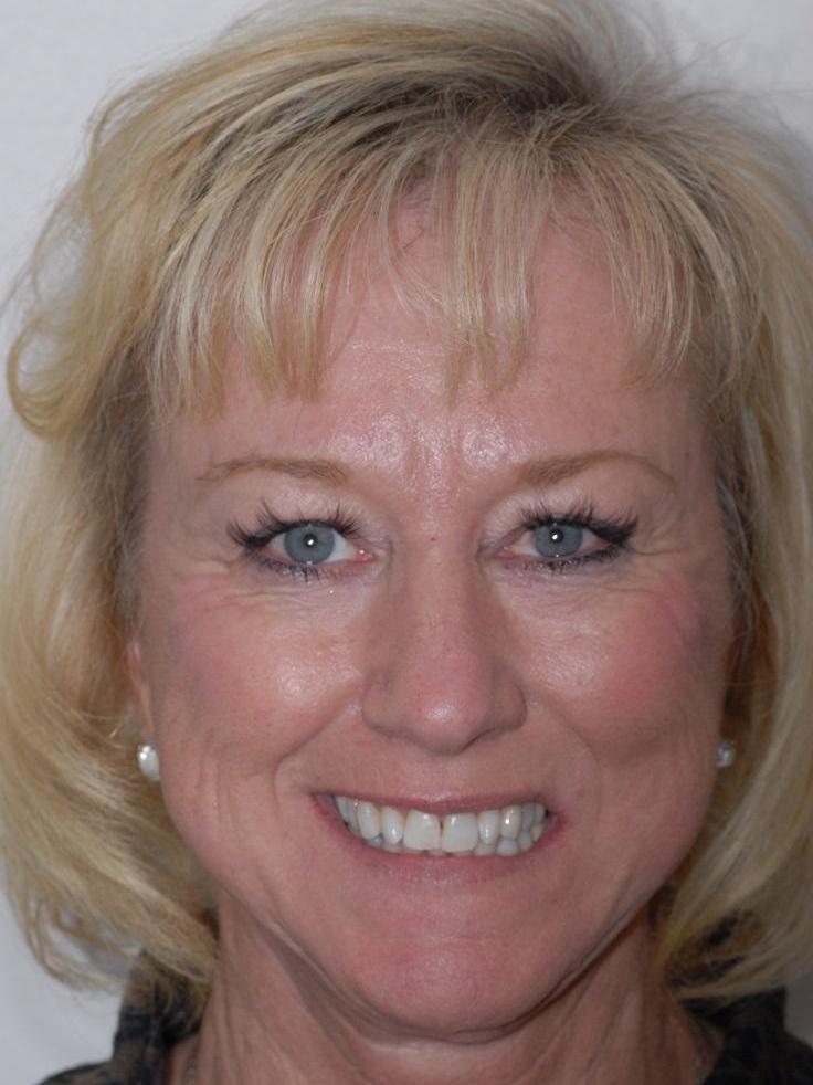 Patine smiling before her new CEREC Crowns