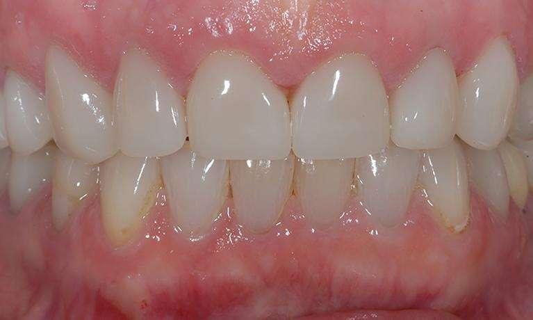 CEREC-Dental-Crown-Smile-Makeover-After-Image