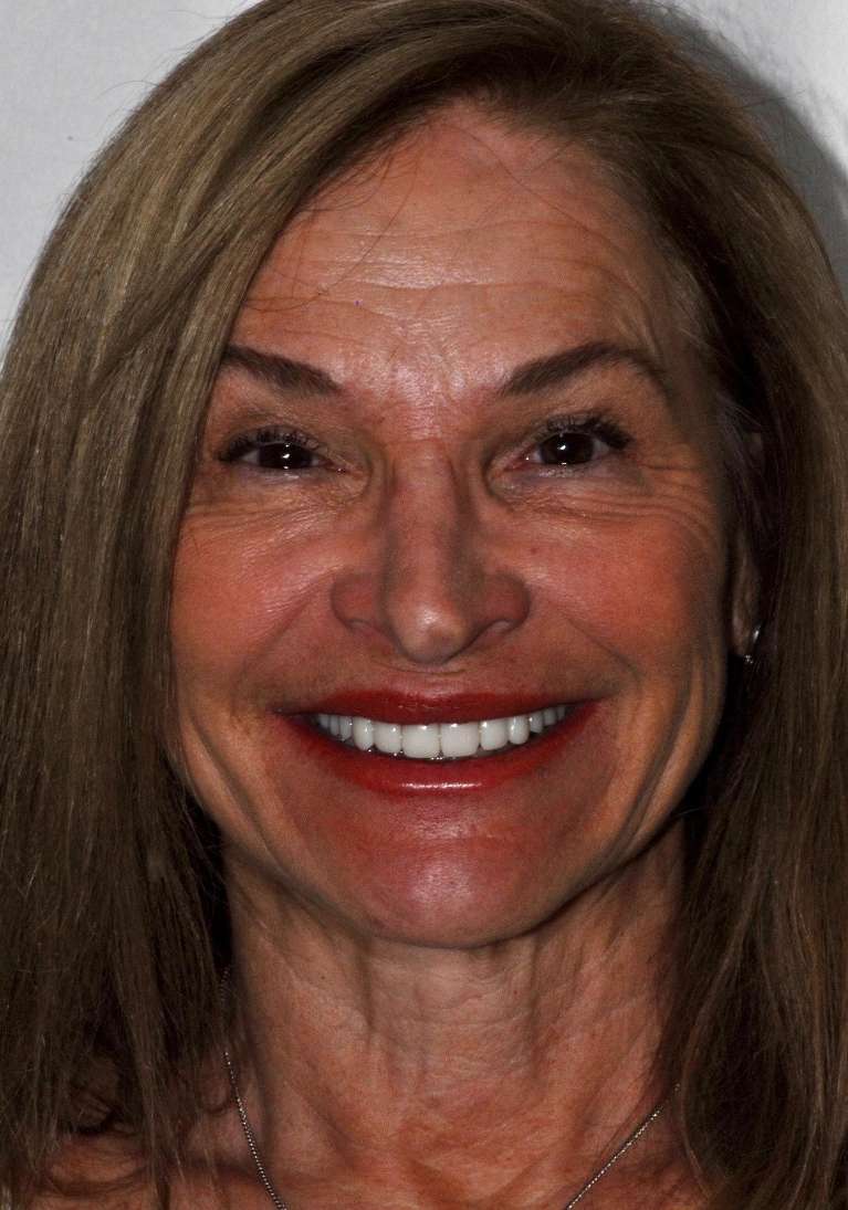 Discover-Smile-Makeovers-After-Image