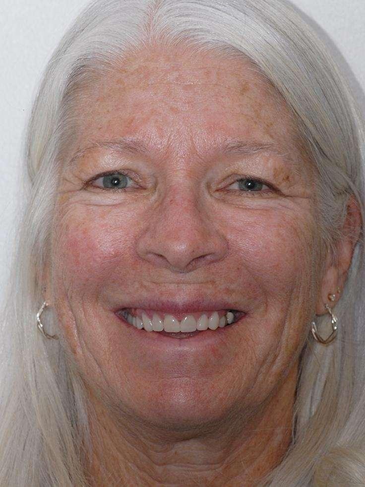 complete smile after cosmetic dentistry | cosmetic dentist centennial co