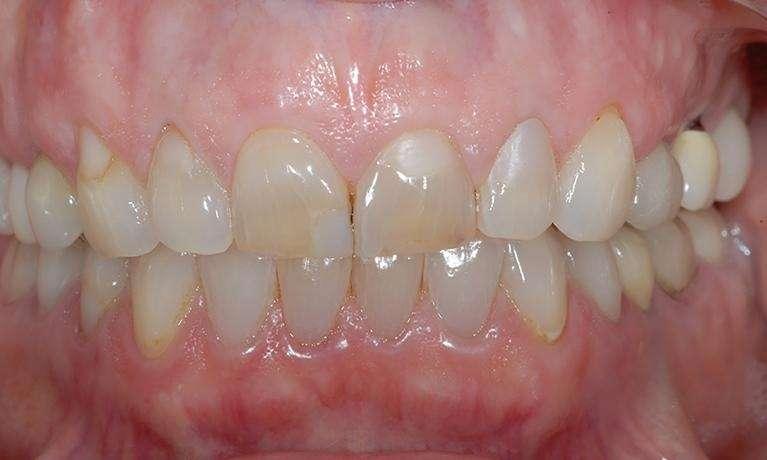 CEREC-Dental-Crown-Smile-Makeover-Before-Image