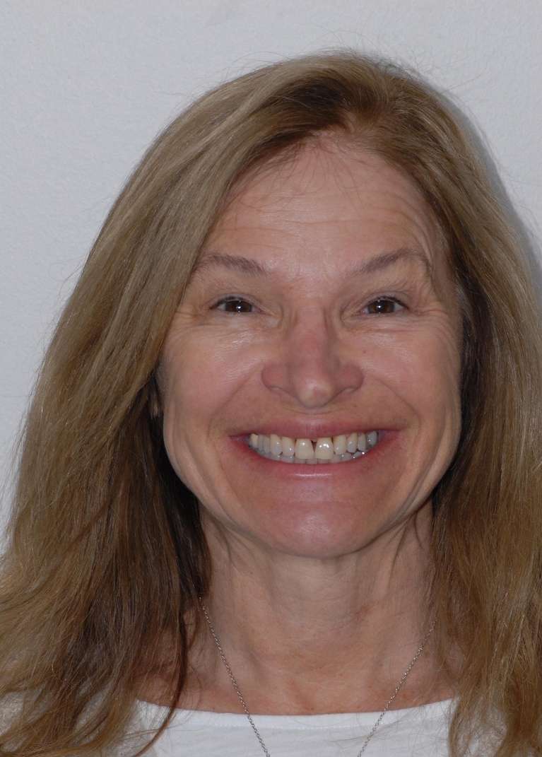 Discover-Smile-Makeovers-Before-Image