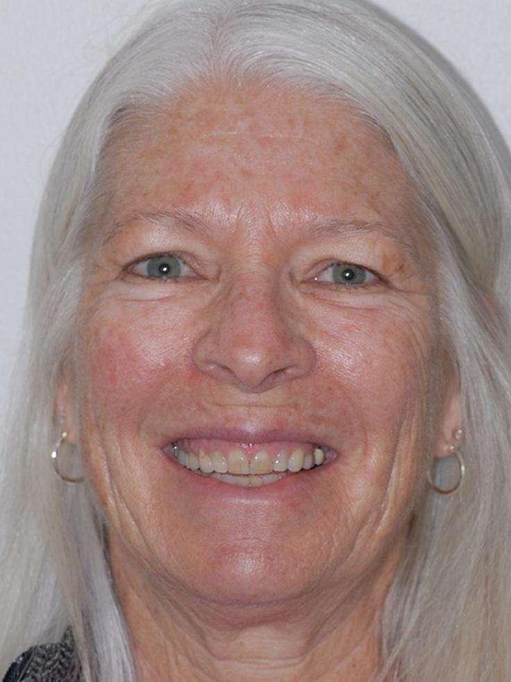 dingy teeth before smile makeover | smile makeovers centennial co